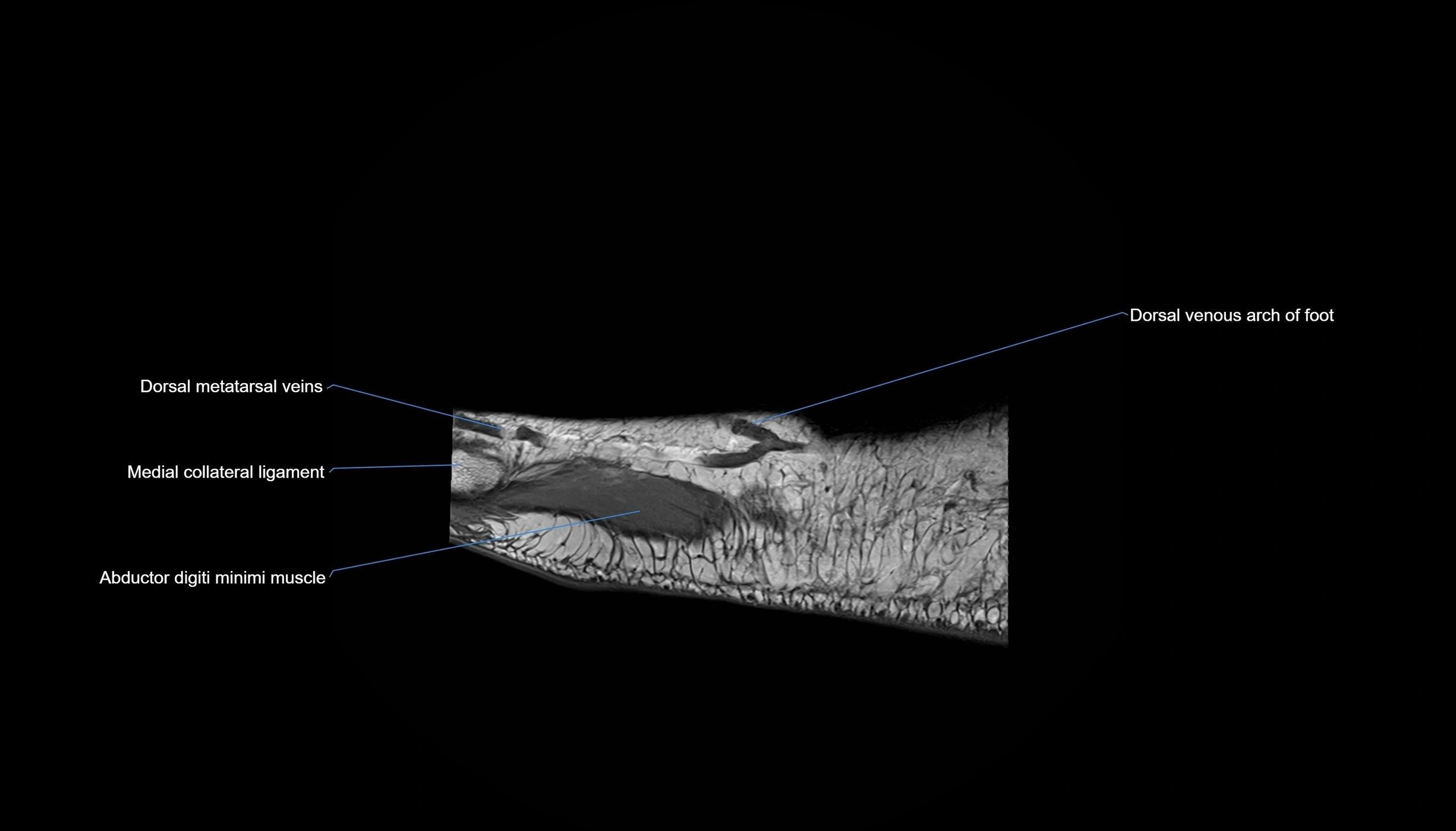 MRI mid foot sagittal cross sectional anatomy 3T  radiology  image-img-00001-00003.webp